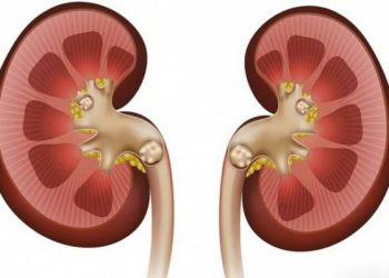 چۆنیەتی خۆپاراستن لە بەردی گورچیلە