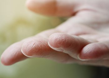 چۆن لە وشکبوونەوەی جەستە ئاگادار بین؟