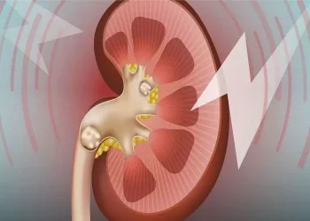 چوار خۆراک کە هۆکارن بۆ دروستبوونی نەخۆشی بەردی گورچیلە و جگەر