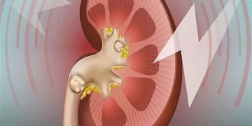 چوار خۆراک کە هۆکارن بۆ دروستبوونی نەخۆشی بەردی گورچیلە و جگەر