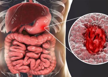لە سەر برینی گەدە چی دەزانین؟