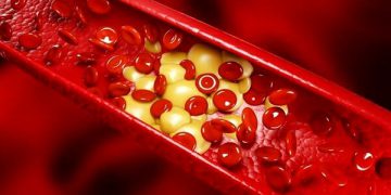 مەترسییە شاراوەکانی بەرزبوونەوەی چەوری خوێن و ڕێگەی سرووشتی بۆ چارەسەرکردنی