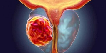 نیشانەکانی گەورەبوونی پرۆستات و چارەسەرکردنی لە ماڵەوە