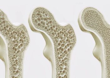 ئەو حاڵەتانەی کە نیشانەی پووکانەوەی ئێسکن