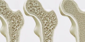 ئەو حاڵەتانەی کە نیشانەی پووکانەوەی ئێسکن