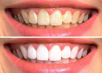 چەندین ڕێگە بۆ لابردنی زەردی ددان