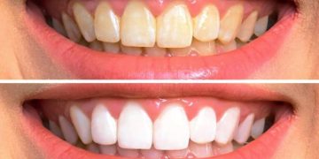 چەندین ڕێگە بۆ لابردنی زەردی ددان