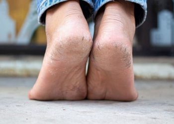 وشکبوونی پێستی پاژنەی پێ به هۆی کەمی ئەم 3 ڤیتامینەیە