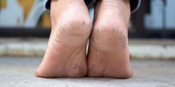 وشکبوونی پێستی پاژنەی پێ به هۆی کەمی ئەم 3 ڤیتامینەیە